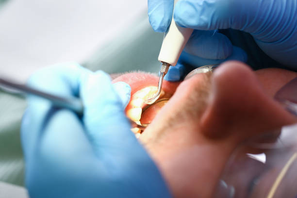 Best Mobile Emergency Dentist in Limesa, CA