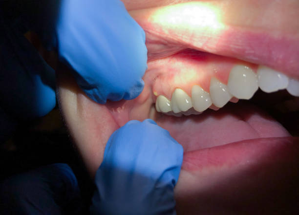 Best Emergency Dentist for Knocked-Out Tooth in Limesa, CA