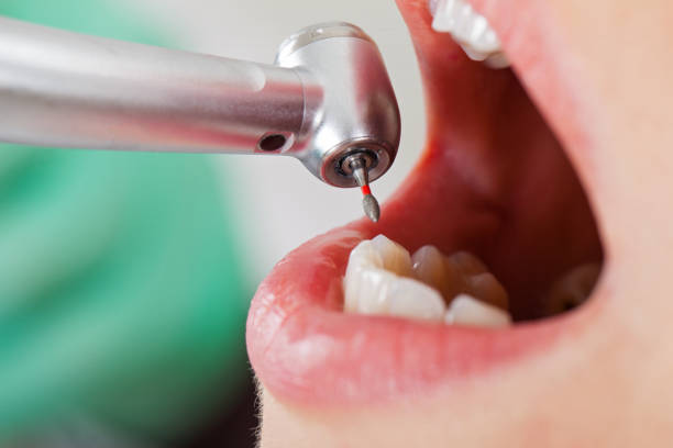 Best Emergency Dentist for Lost Fillings or Crowns in Limesa, CA